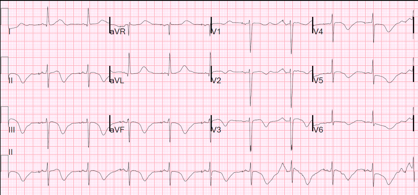 Dr. Smith's ECG Blog: Long QT Syndrome with Continuously Recurrent Polymorphic VT: Management